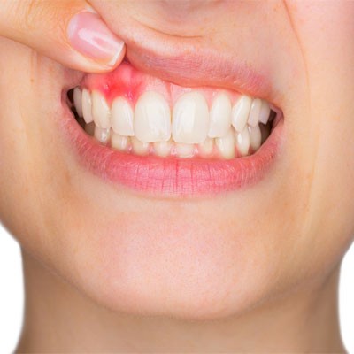پریودنتیت یا التهاب لثه چیست؟