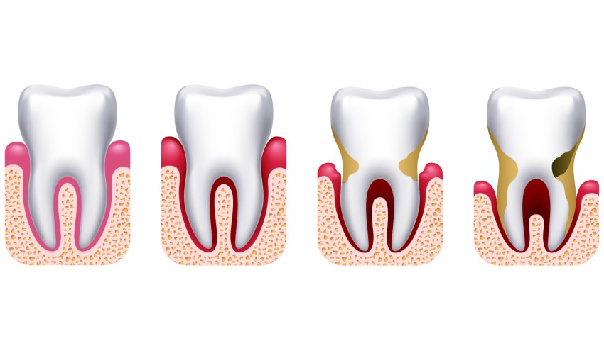 پریودنتیت یا التهاب لثه چیست؟