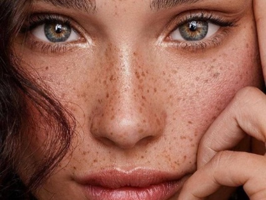 همه چیز درباره از بین بردن لک های صورت